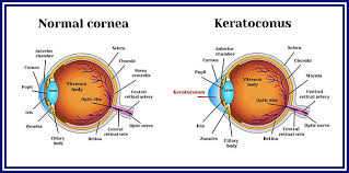 keratoconus Eye Treatment