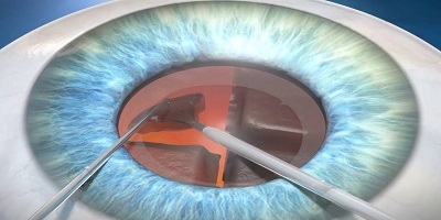 Cataract Surgery Haryana govt empanelled ( Cashless medical facility