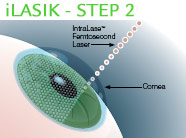 Laser Vision Correction