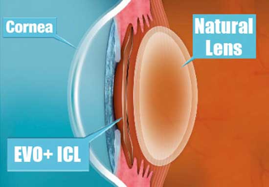 Implantable Collamer Lens​