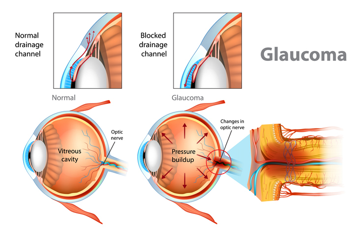 Glaucoma Tratment