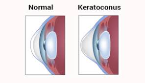 Keratoconus (from greek: kerato- horn, cornea; and konos cone)